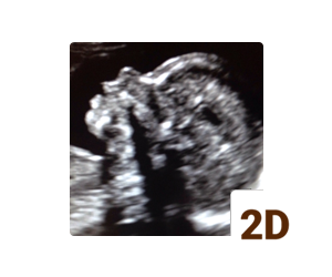 2d ultrasound gilbert